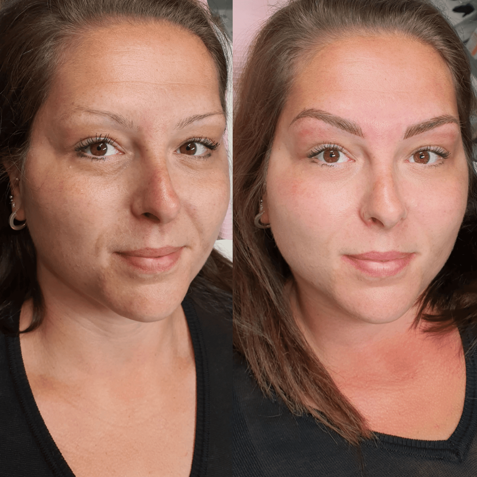 Eyebrow tattoo removal Amsterdam