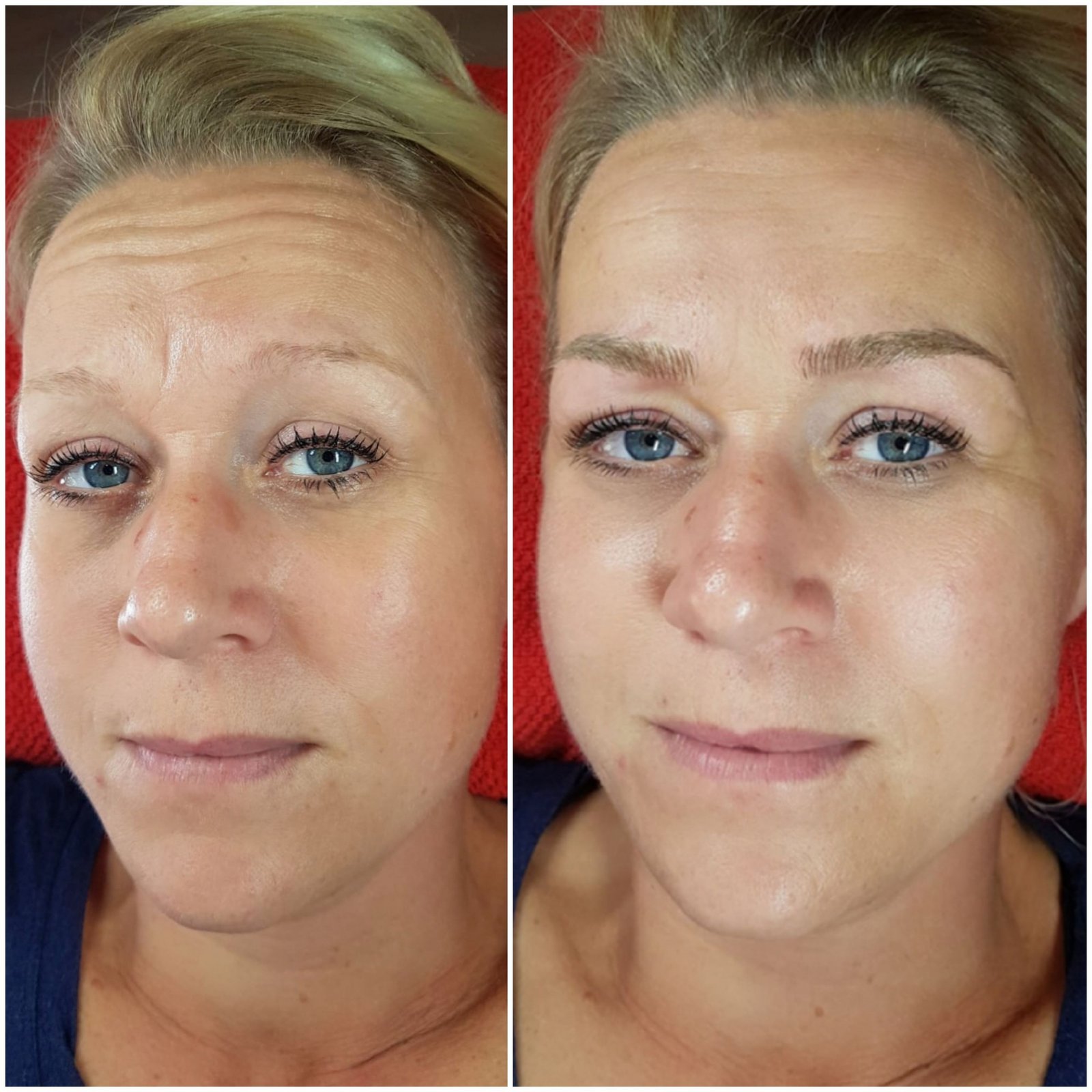 Eyebrow tattoo removal Amsterdam