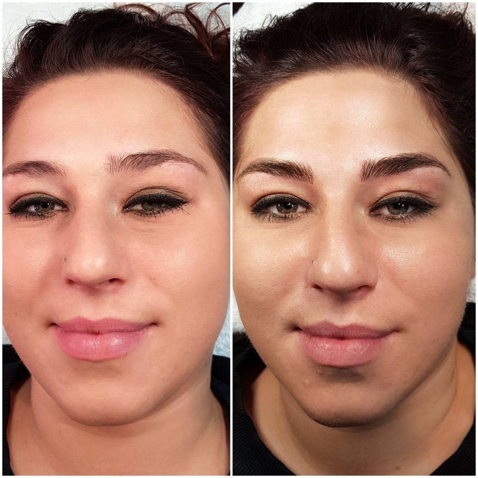 Eyebrow tattoo removal Amsterdam