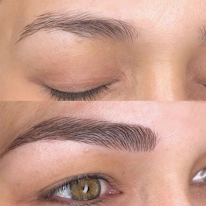 Eyebrow tattoo removal Amsterdam