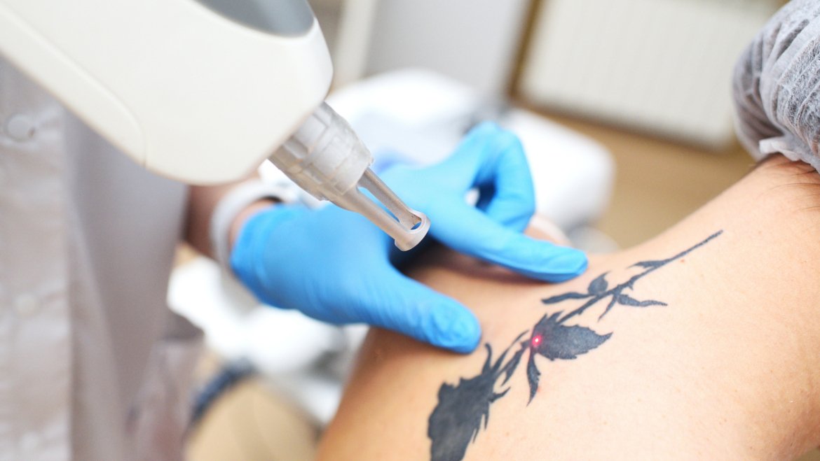 Tattoo Removal
