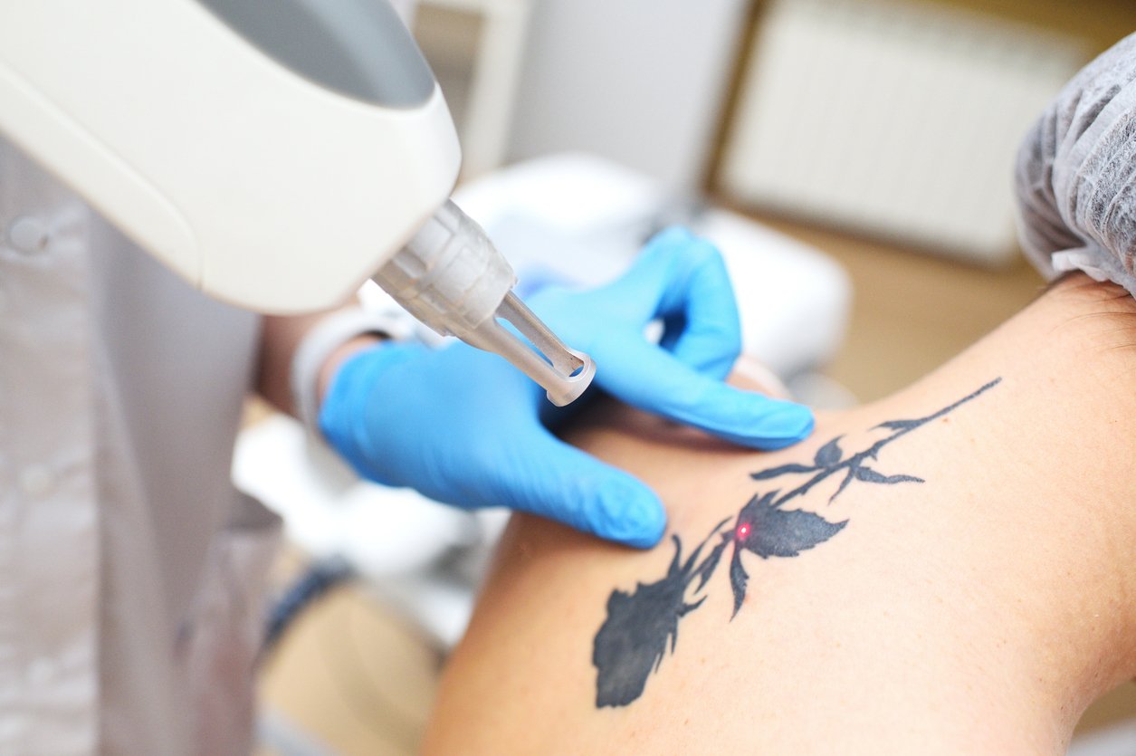 Laser tattoo removal at Beauty Lounge Amsterdam, professional tattoo removal in Amsterdam