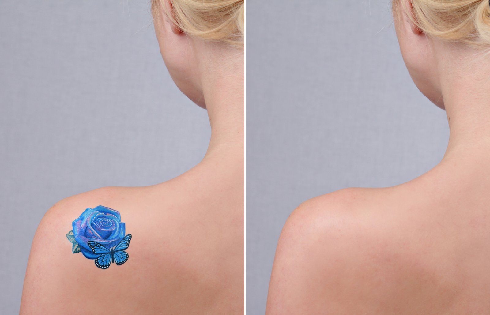 Tattoo removal Amsterdam