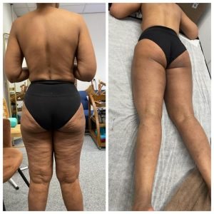 madero-therapy-anti-cellulite-amsterdam